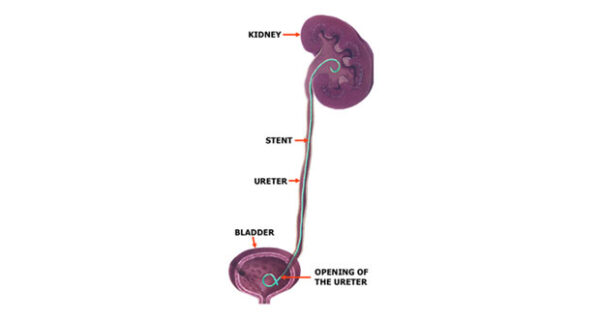 Tract Double J Stent treatment | Dr. K. Ramesh – Chennai Urology